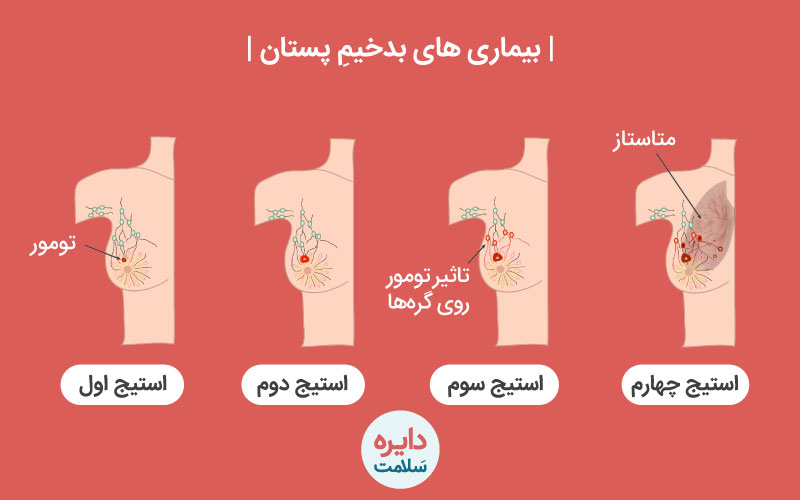 بیماری های بدخیم پستان