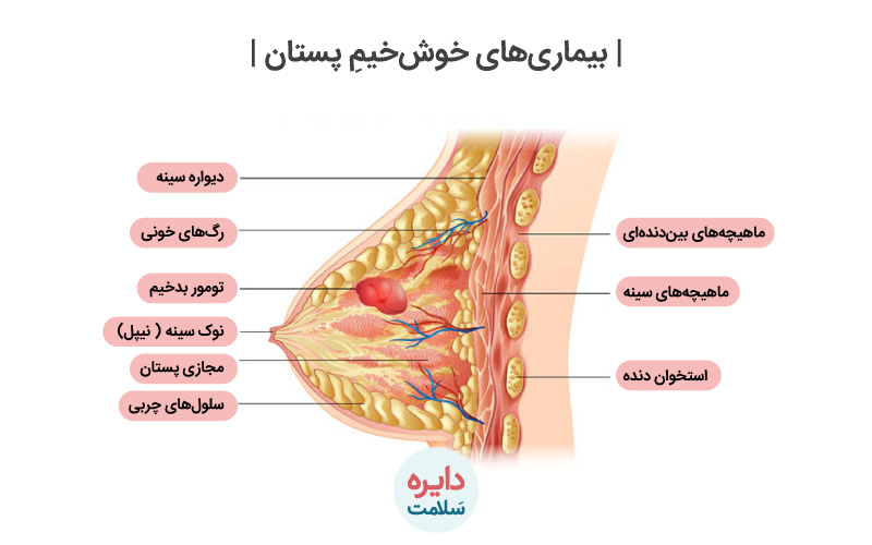 بیماری های خوش خیم پستان