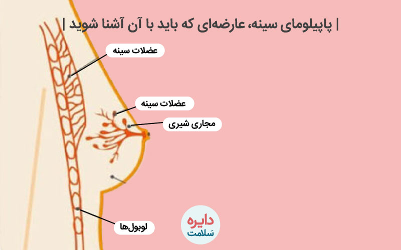 پاپیلومای سینه 2