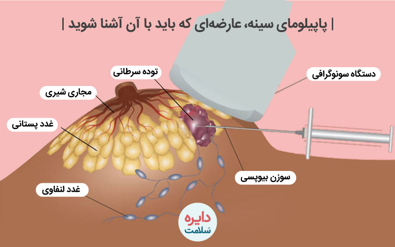 پاپیلومای سینه1