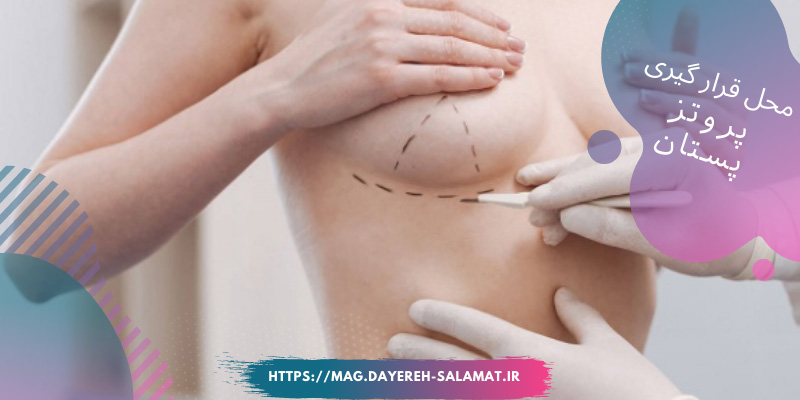 محل قرارگیری پروتز پستان