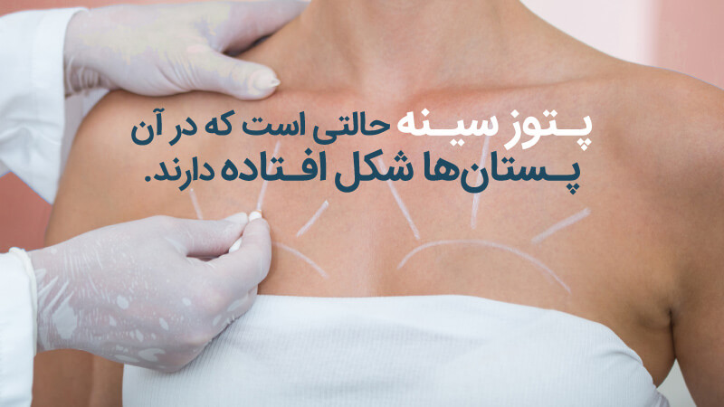 افتادگی سینه